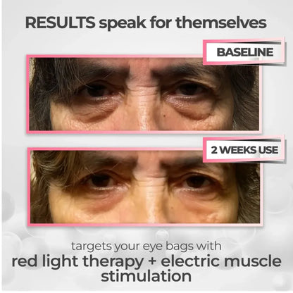 RevitalEyes® 2-in-1 Red Light Therapy + EMS To Erase Eye Bags